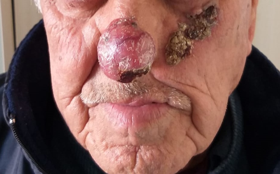 Yüzde Cilt Kanseri Belirtileri